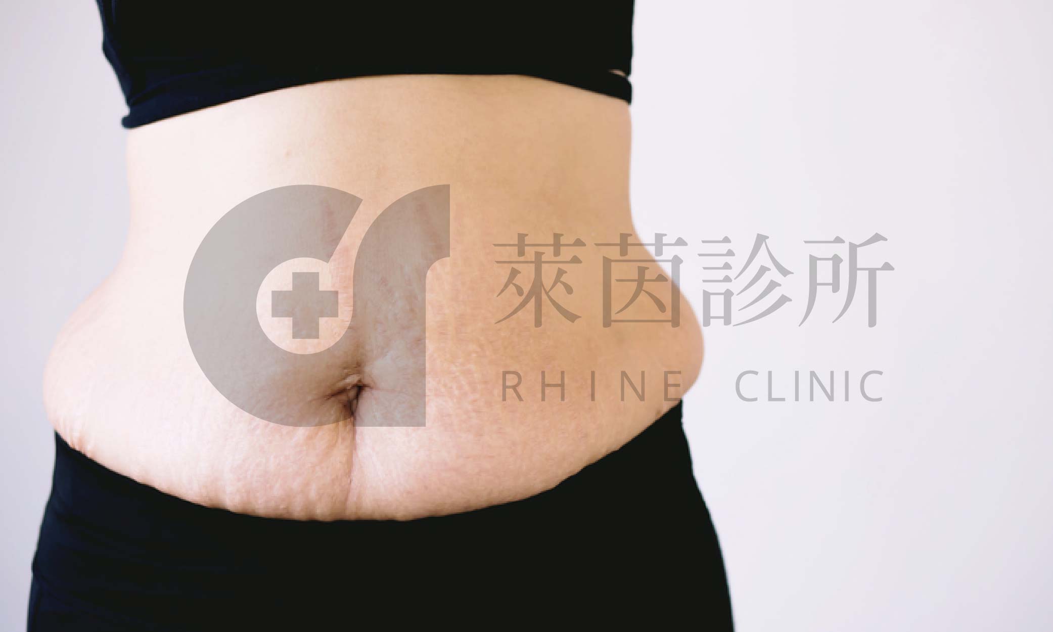 產後肚皮示意圖，小腹容易變得鬆弛且出現妊娠紋和脂肪堆積